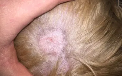 Närbild på hundens hud med en fläck som kan behöva ringorm behandling. Huden är röd och lite fjällande.