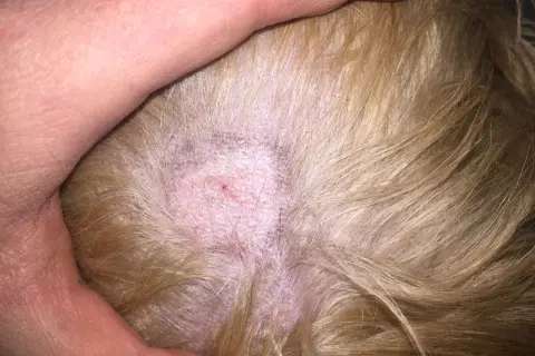 Närbild på hundens hud med en fläck som kan behöva ringorm behandling. Huden är röd och lite fjällande.