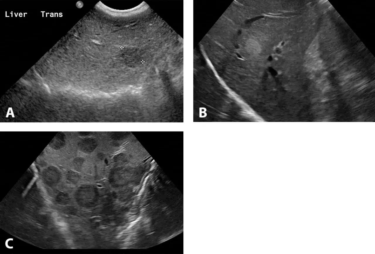 Ultraljudsbilder av hundlever visar tecken p&aring; leversjukdom. Bild A visar m&auml;tningar av en lesion. Bild B visar en annan del av levern. Bild C visar en lever med flera cystor.